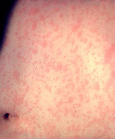 Measles.jpg